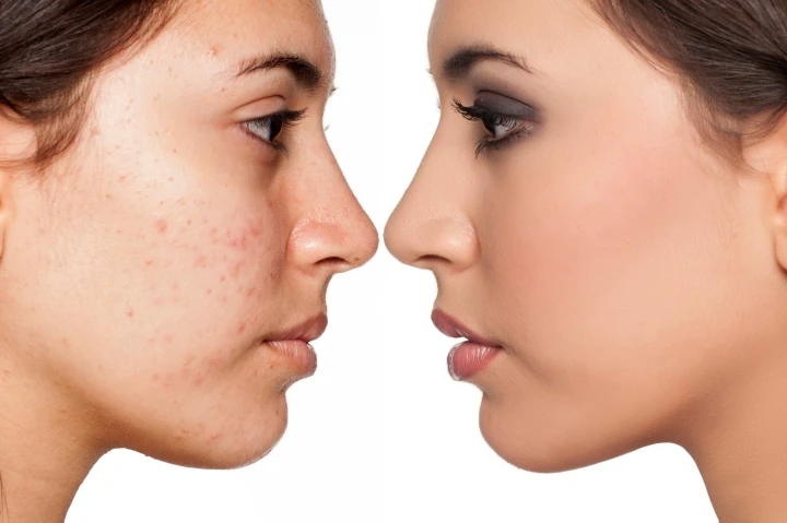 Acne treatment most effectively, leaving no sequelae on the skin