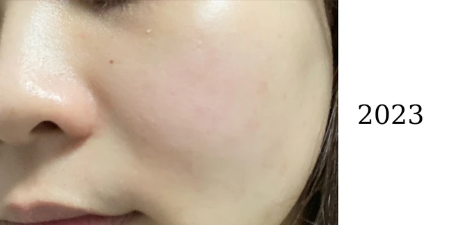 Compliance with 3 Tips Skincare, she holds smooth skin without acne for 4 years